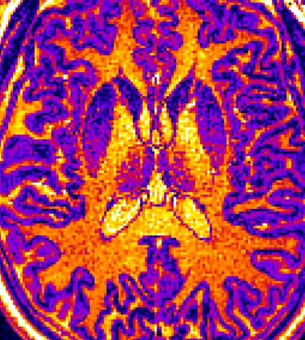 Connection Between Multiple Sclerosis and Depression Uncovered