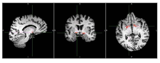 Brain Lesions in Former Football Players Linked to Vascular and Brain Changes