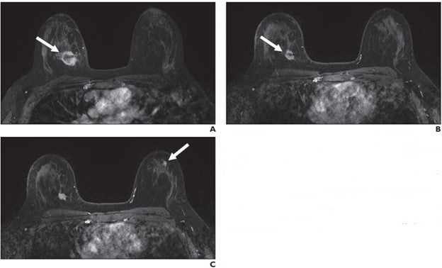 AI Tool May Detect Metastatic Breast Cancer in MRI