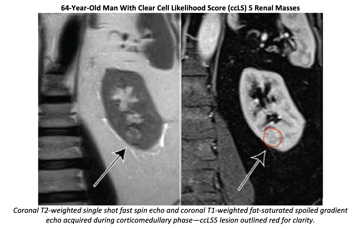 MRI Derived Score Correlates with Renal Mass Growth Rate