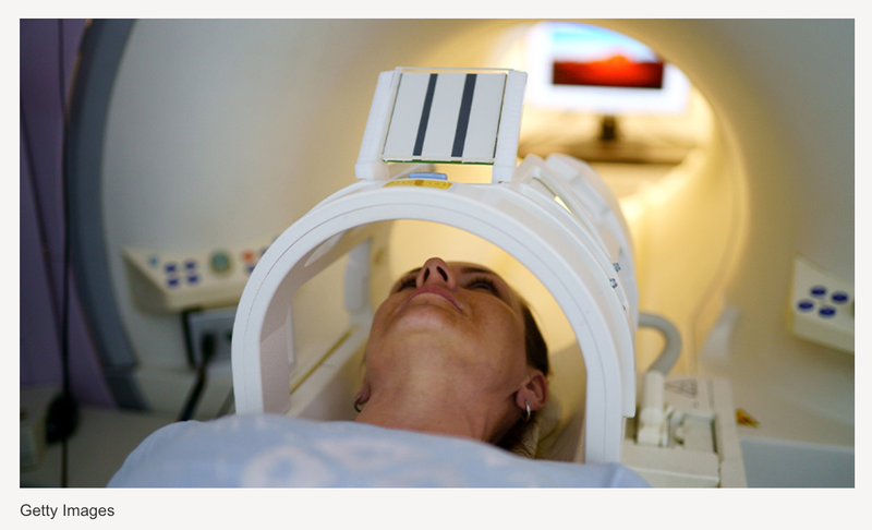MRI Shows Structural Abnormalities in People with Functional Seizures