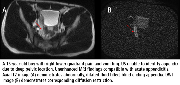 MRI exams for suspected pediatric appendicitis may not require contrast for most patients