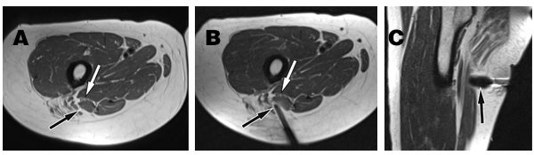 MRI-guided cryoablation for treatment of neuropathy-mediated sitting pain