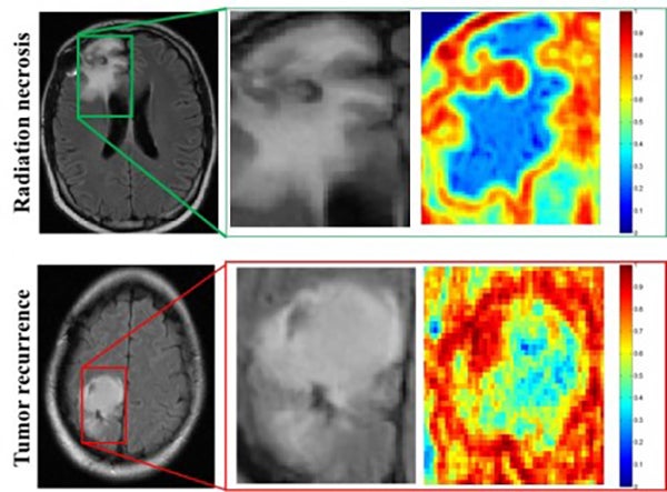 Study Supports Use of the NeuroBlate System for Radiation Necrosis