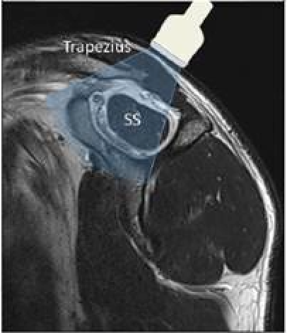 Multiple Societies Release Consensus Statement for MSK and Sports Medicine Ultrasound