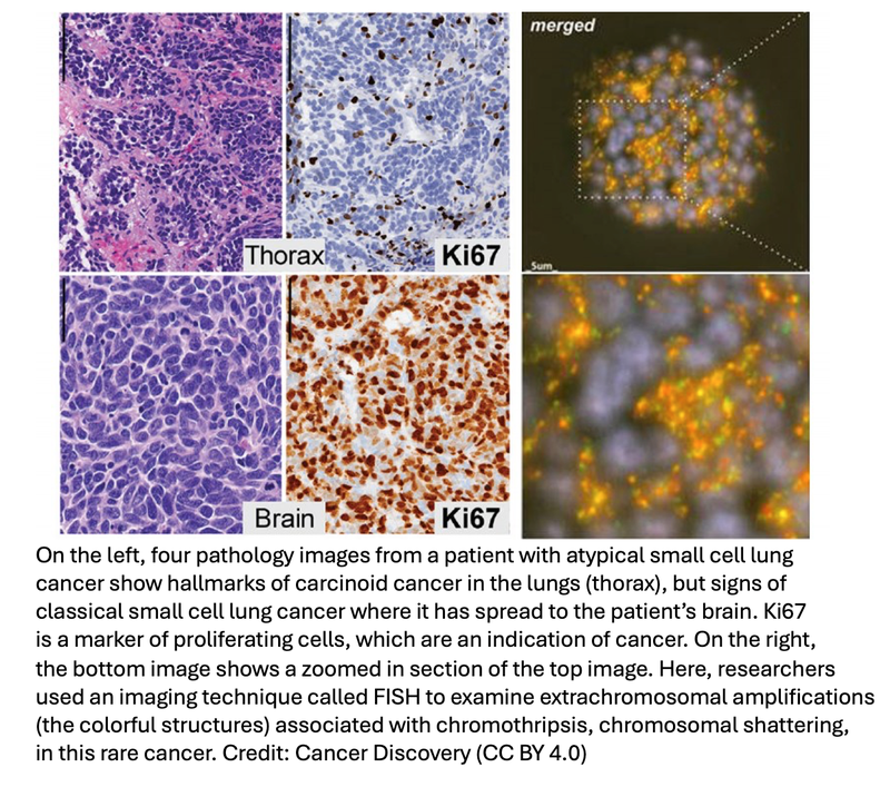 Research Team Identifies New, Rare Type of Small Cell Lung Cancer