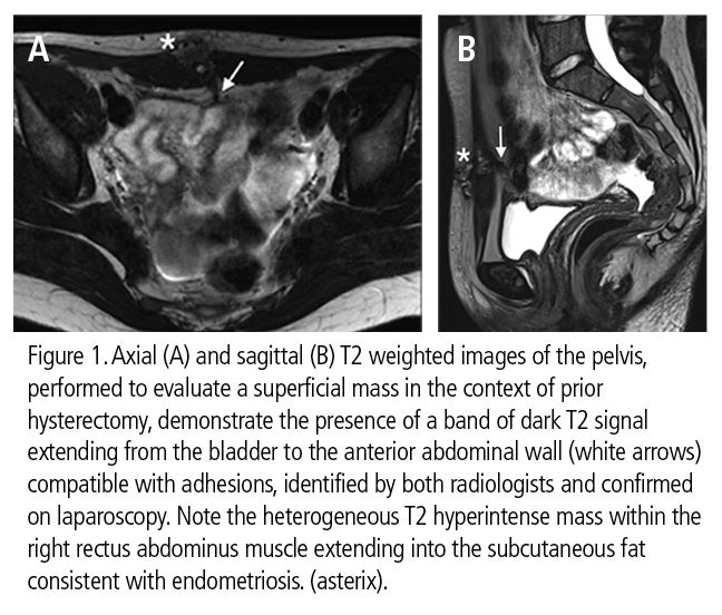MRI useful for evaluation of pelvic adhesions