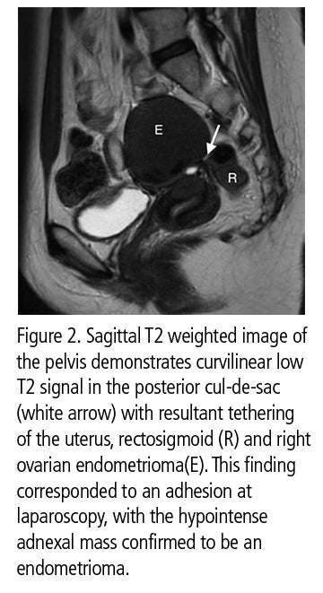 MRI useful for evaluation of pelvic adhesions