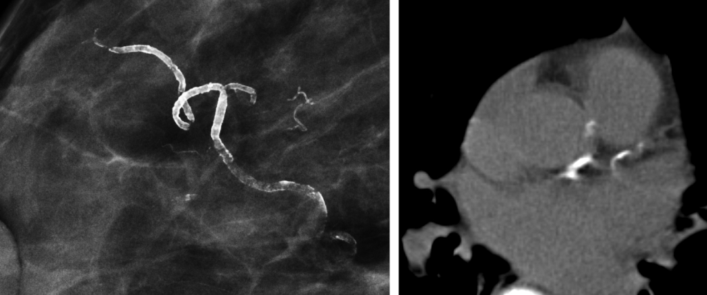 Digital mammography: A potential screening tool for coronary artery disease