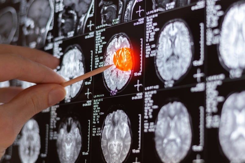 AI Model Detects Spread of Metastatic Brain Cancer on MR Images