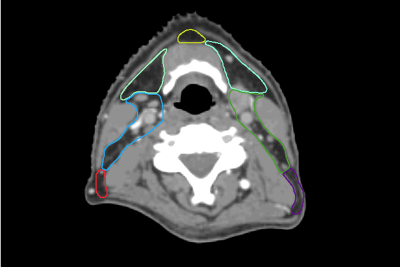 AI Segmentation Software for Radiation Therapy Planning Introduced in Canada