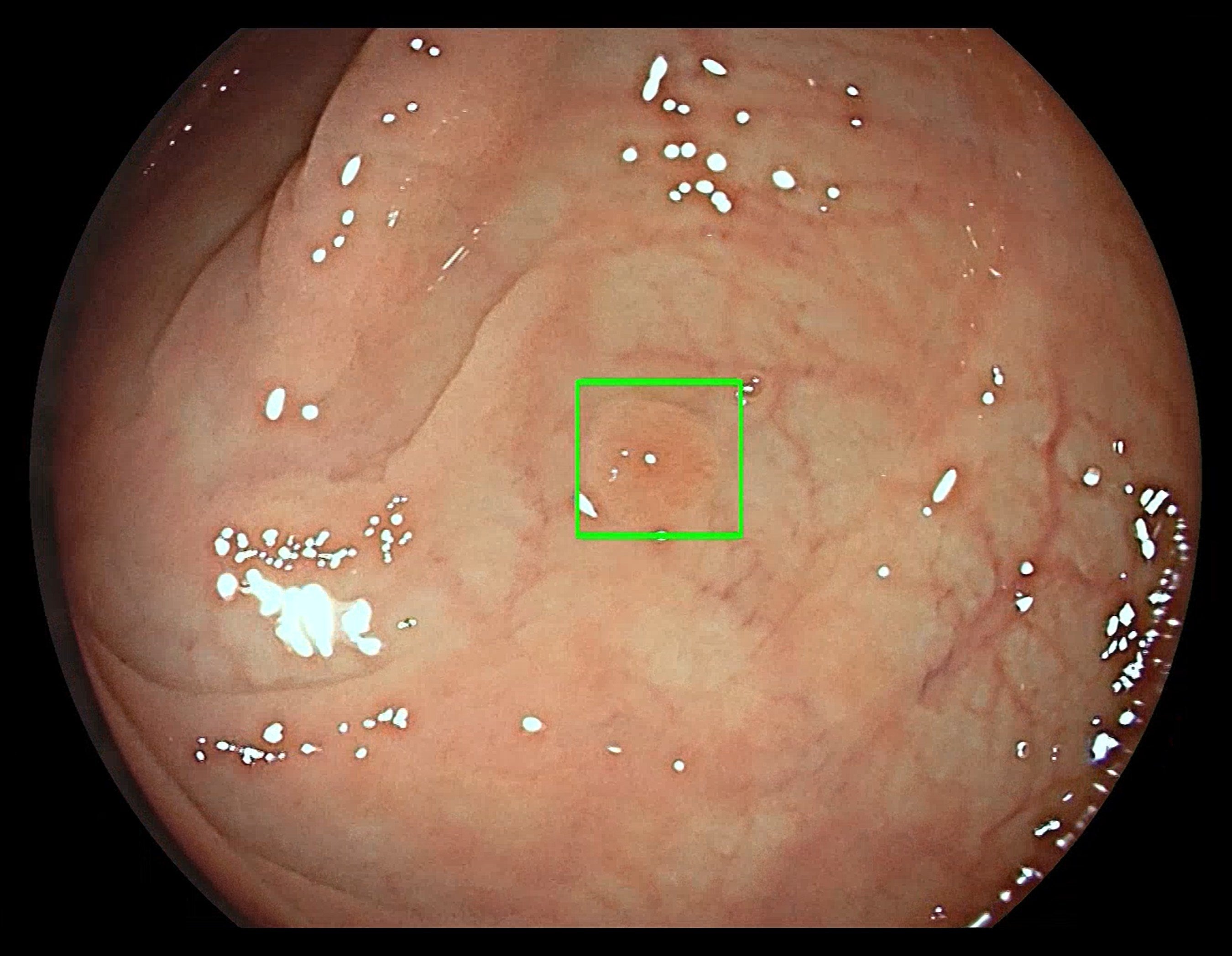 FDA Grants de novo Clearance for First AI-based CADe System for Colorectal Polyps