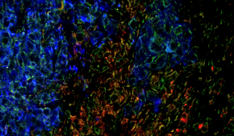 Preoperative Stereotactic Radiosurgery Improves Outcomes in Metastatic Brain Cancer