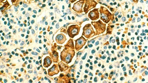 Researchers Discover Genetic Predisposition Increases Risk of Breast Cancer Metastasis