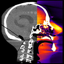July 18 - AAPM: Mobile CT Scanner Could Help Diagnose Brain Injury on the Spot