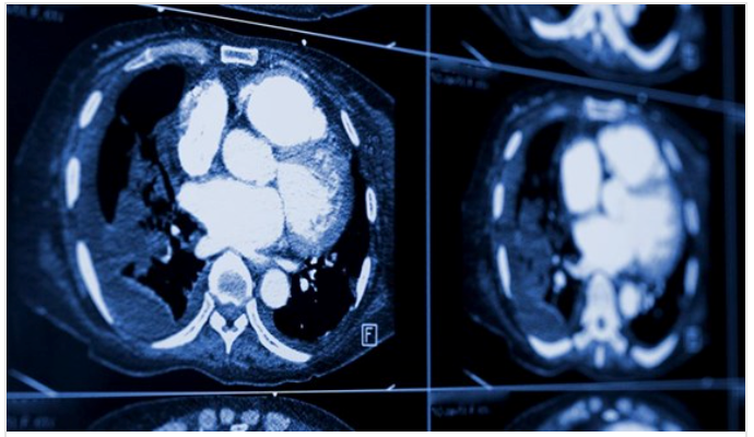 Radiomics Model Developed by Moffitt Researchers Predicts Poor Lung Cancer Outcomes