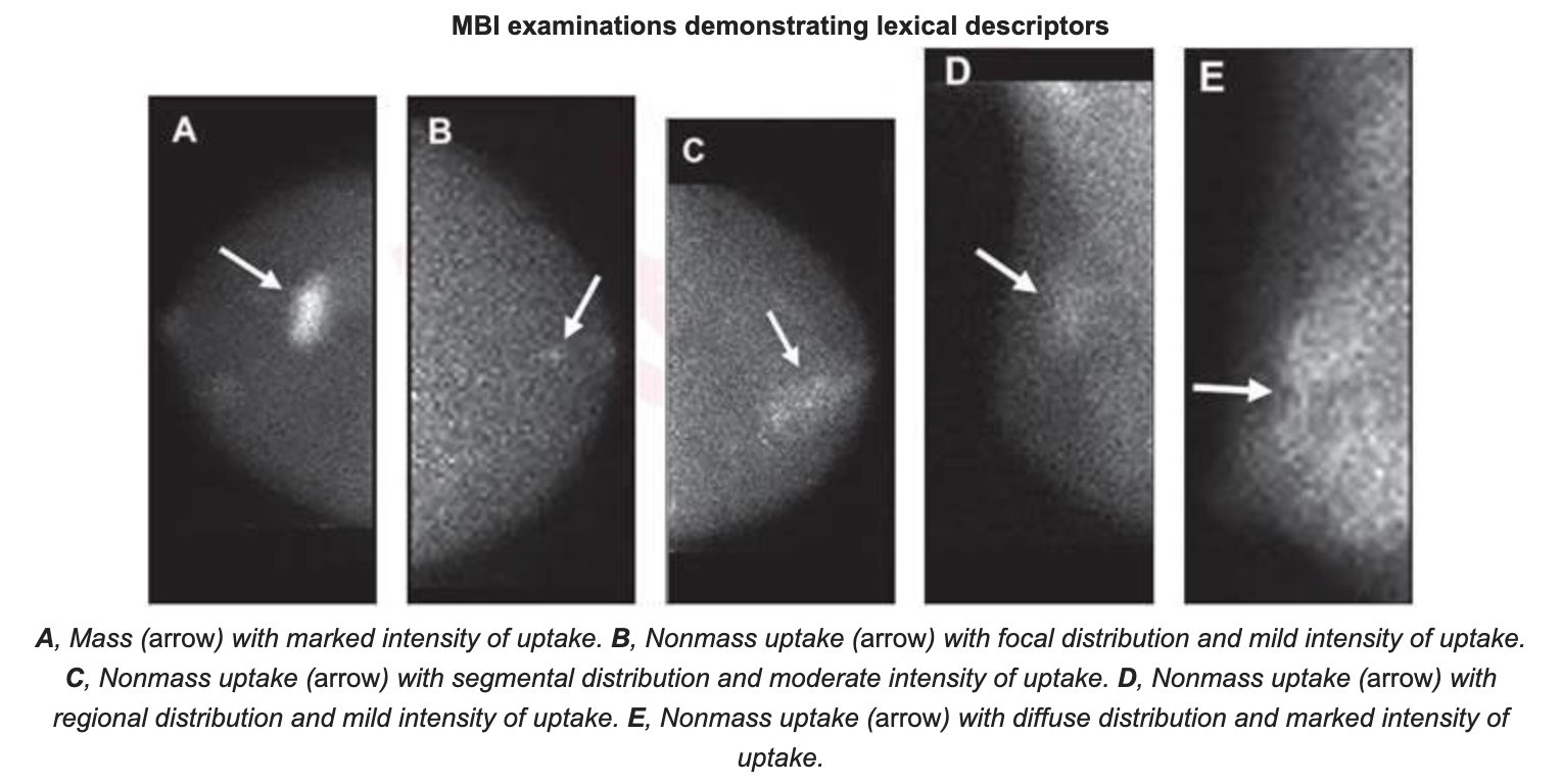 Molecular Breast Imaging Lesion Descriptors Guide Interpretations
