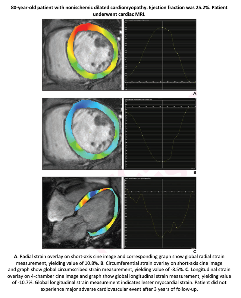 Myocardial Strain a Predictor of Adverse Outcomes in Dilated Cardiomyopathy Patients