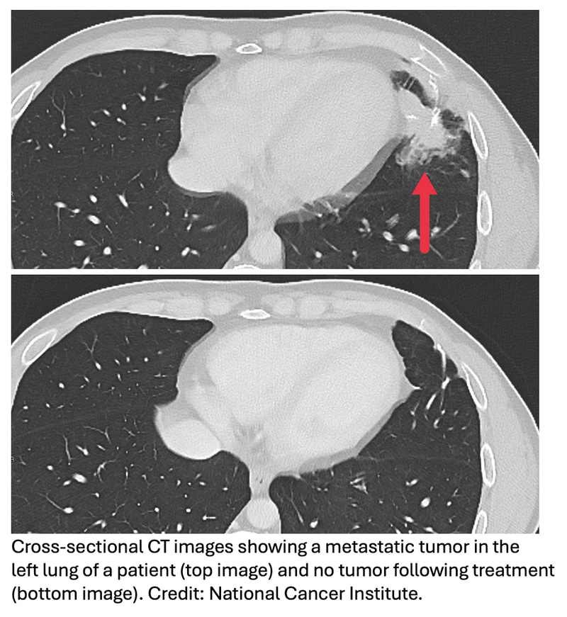 New Immunotherapy Approach Shows Potential in Metastatic Solid Tumors