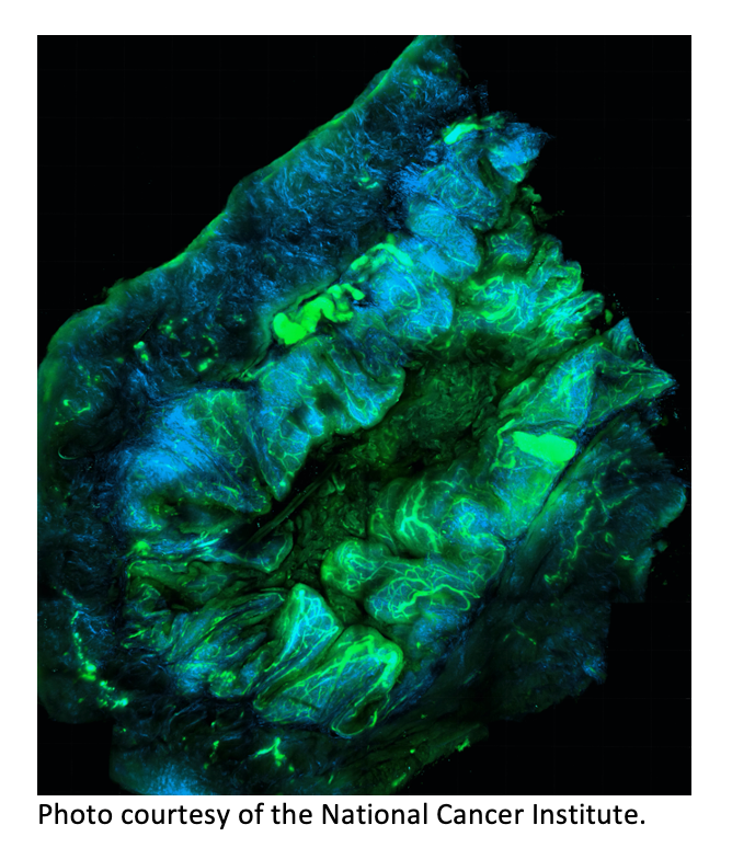 Researchers Identify Factors That Boost Immunotherapy Effectiveness in Recurrent Ovarian Cancer