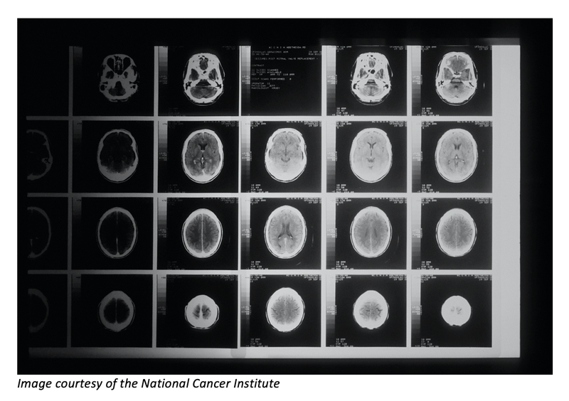 Fewer Surveillance MRIs for Incidental Pituitary Lesions is Safe