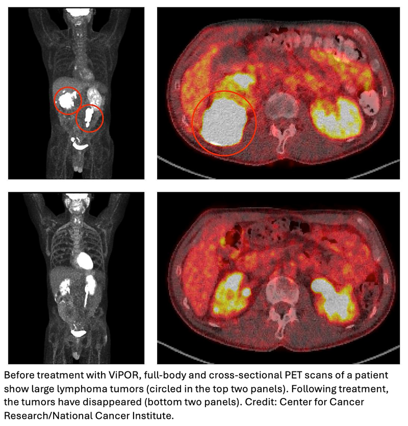 Combination Therapy Delivers Lasting Remissions in Resistant Aggressive B-Cell Lymphoma Patients