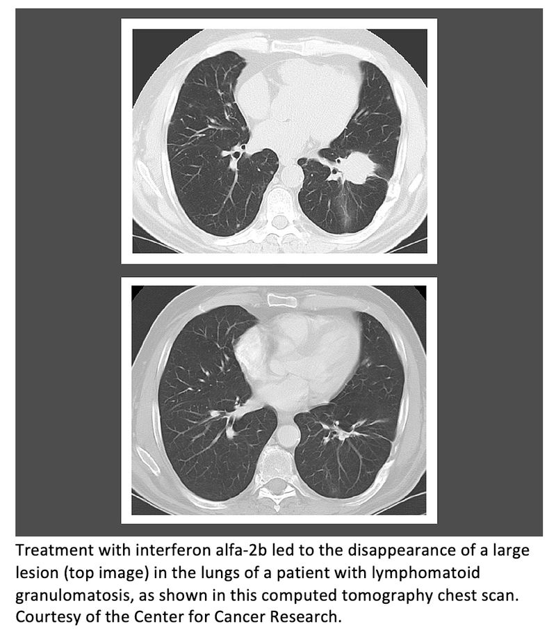 Immunotherapy Substantially Increases Survival in Lymphomatoid Granulomatosis Patients