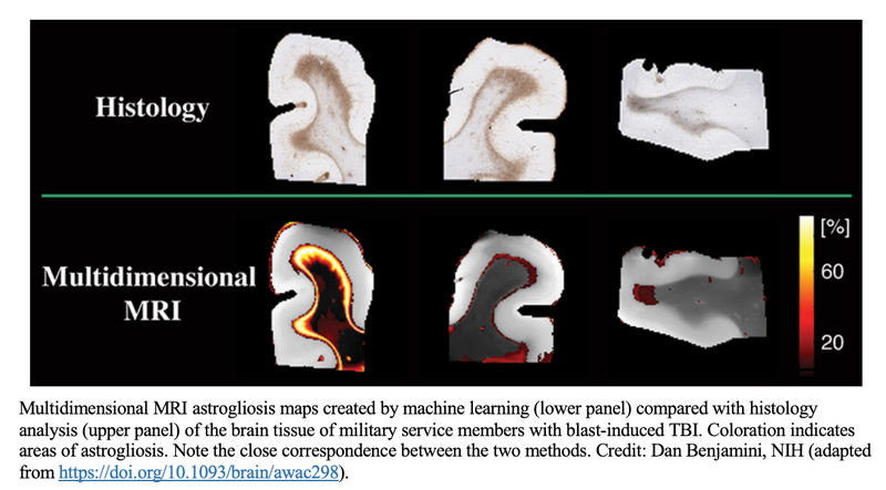 Multidimensional MRI Detects “Invisible” Brain Injury