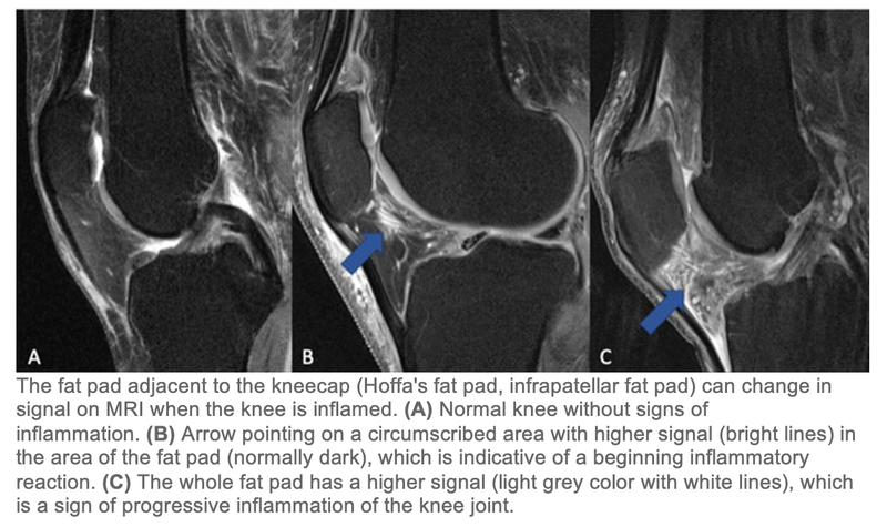 NSAIDS May Worsen Knee Arthritis Inflammation