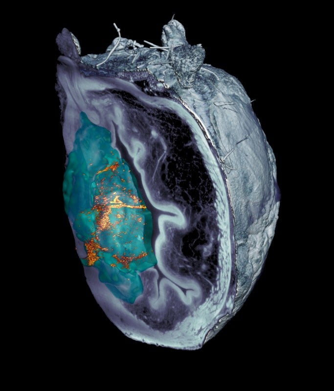 Nanorobots Delivering Localized Therapy Reduce Bladder Tumors by 90%