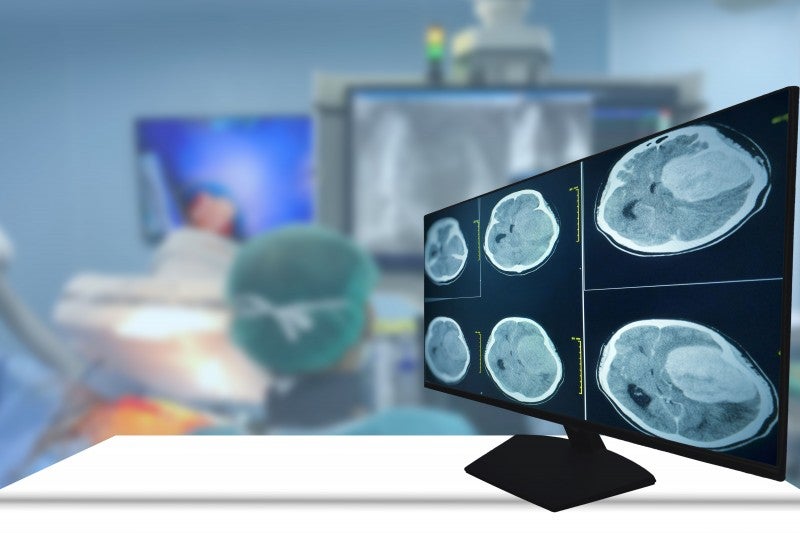 Treatment Approach Shows Promise Against Glioblastoma