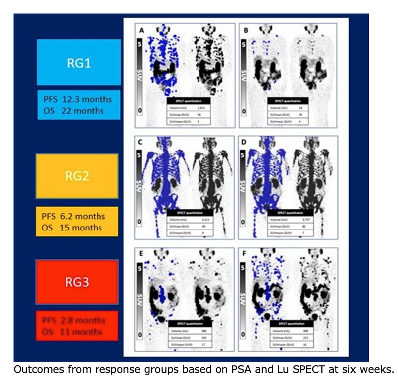 Prostate Cancer Patient Outcomes Improve With Personalized Dosing