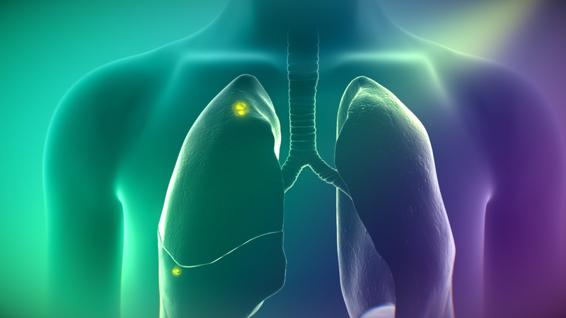 FDA Approves Expanded Indication for CYTALUX Molecular Imaging Agent in Lung Cancer Detection