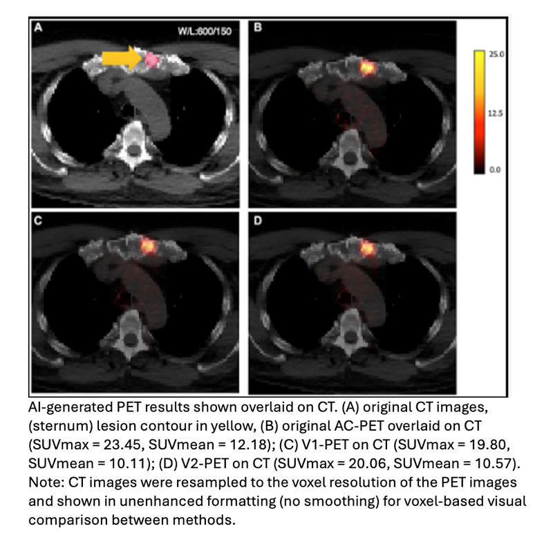 DL-Based Algorithm Produces Attenuation-Corrected PET Images