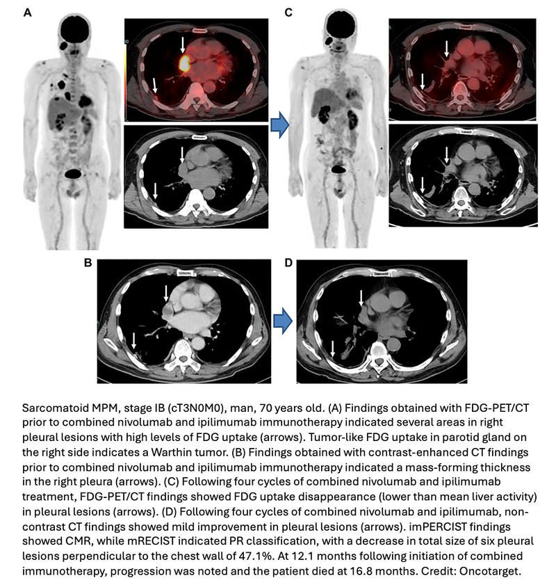 Study Compares FDG-PET/CT and CT for Treatment Evaluation in Patients With Unresectable Pleural Mesothelioma