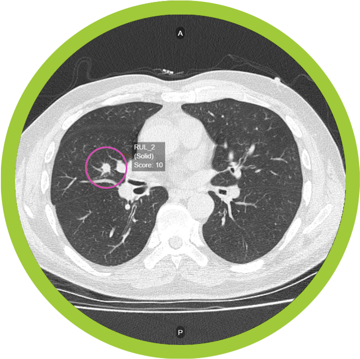 AI-Powered Clinical Decision Support Software for Early Lung Cancer Diagnosis Gets FDA Nod