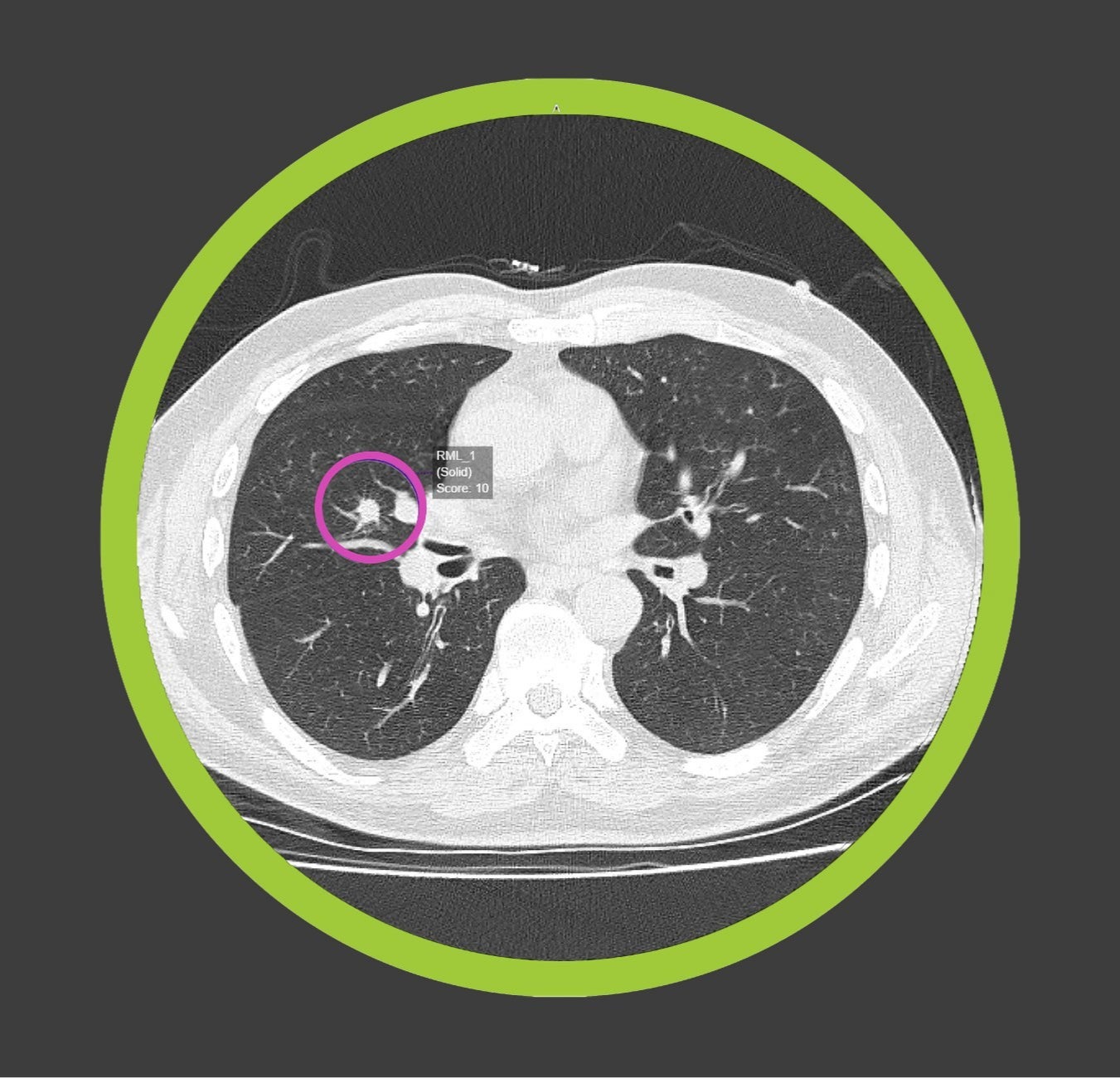 Optellum Collaborates with the Lung Cancer Initiative at J&J