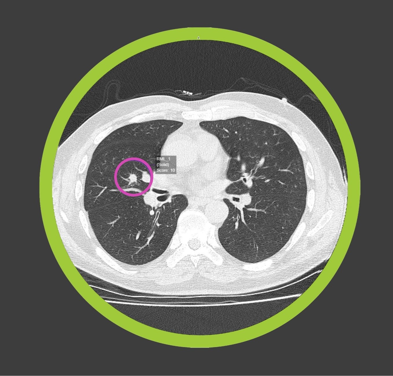 Optellum Collaborates with the Lung Cancer Initiative at J&J