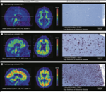 First Paper Published on European Consensus for MCI, Mild Dementia Diagnosis