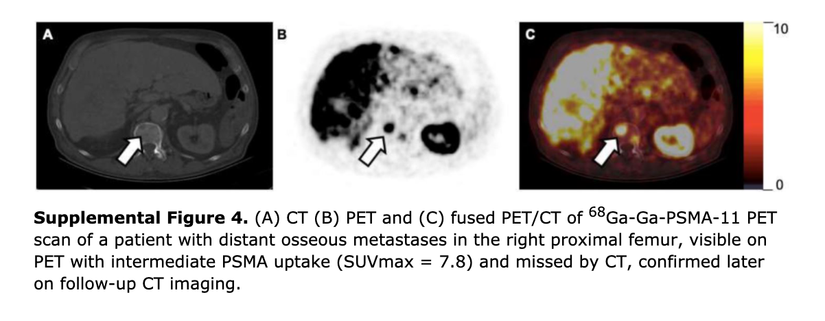 PSMA PET Imaging Accurately Detects Hepatocellular Carcinoma