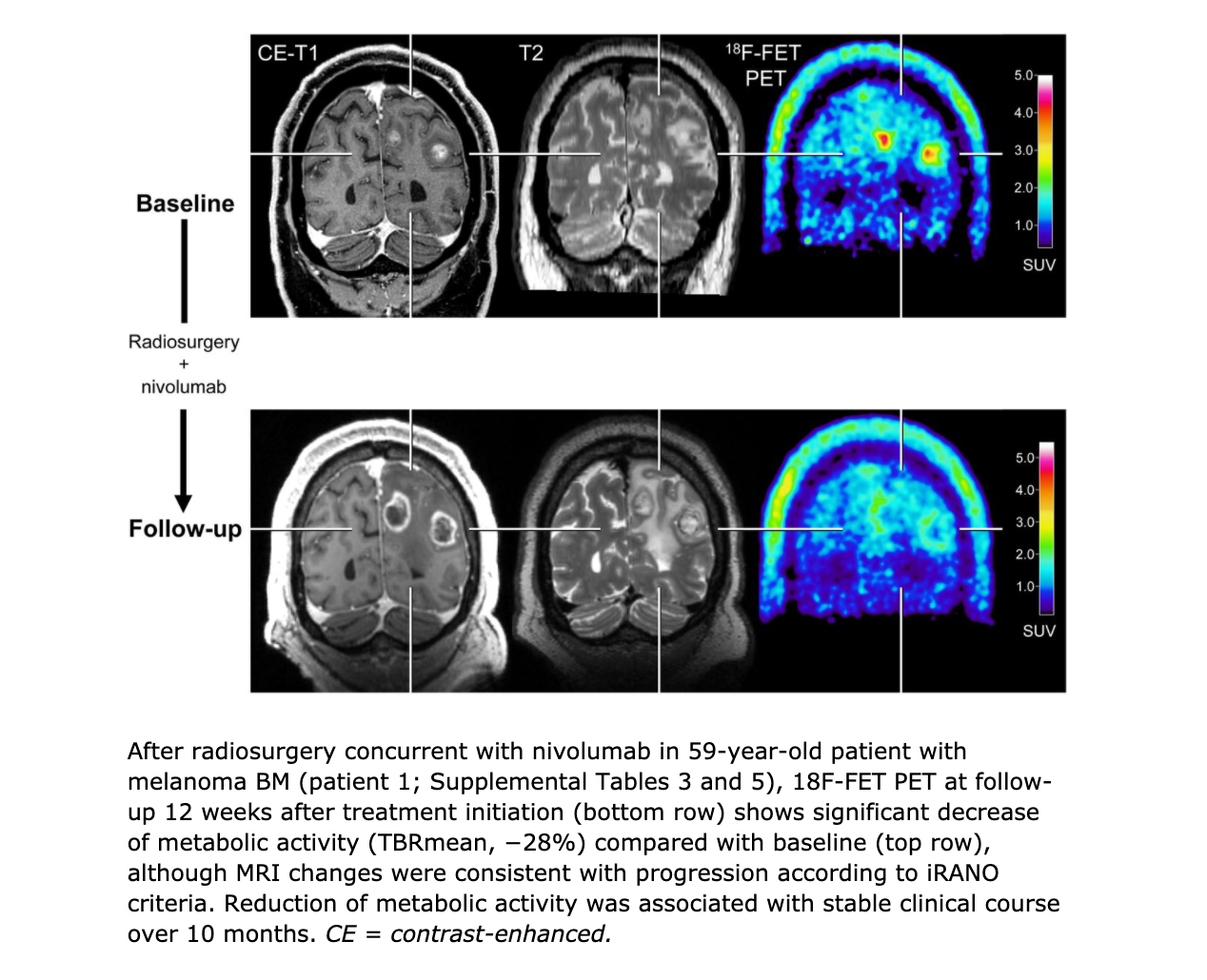 PET Imaging Provides Valuable Information for Monitoring Brain Metastases