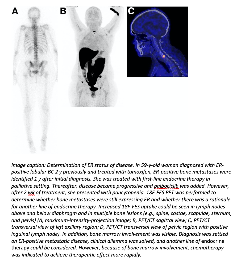New PET Imaging Agent Supports Personalized Treatments for Breast Cancer Patients