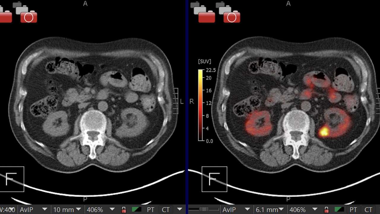 PET Imaging Method Accurately Detects Aggressive Kidney Cancer