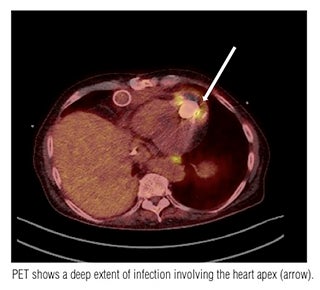 Infections identified by 18F-FDG PET in patients with ventricular assist devices