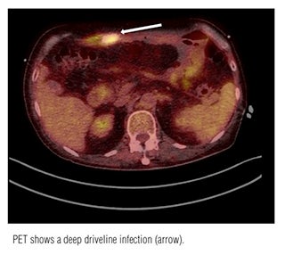 Study Finds Biomarkers in PET/CT and Blood are Indicators of Active Sarcoidosis