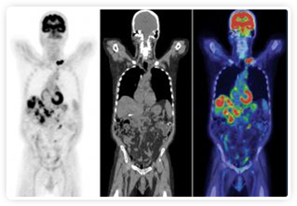 Imaging May Improve Clinical Guidance in Immunotherapy