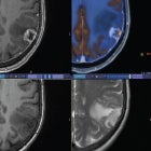 Imaging May Improve Clinical Guidance in Immunotherapy