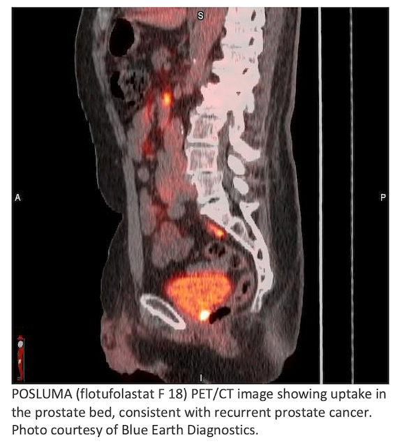POSLUMA May Help Identify Recurrence of Prostate Cancer After Radical Prostatectomy