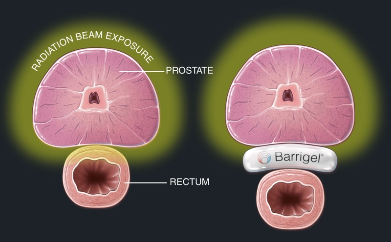 Barrigel Rectal Spacer Gets FDA Clearance