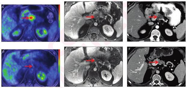 FDG-PET Predicts Neoadjuvant Therapy Response in Pre-Op Pancreatic Cancer Patients